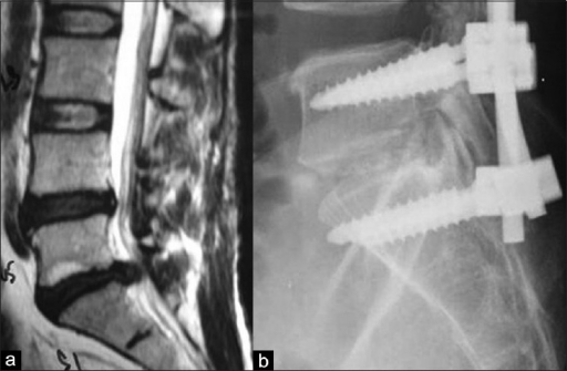 (a) T2W sagittal MRI of lumbosacral spine showing L5S1