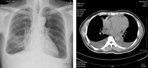 Image studies of the patient. (A) A chest X-ray; (B) a | Open-i