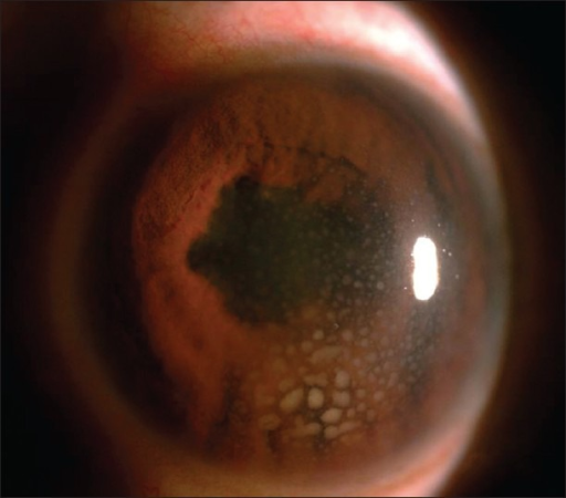 anterior granulomatous uveitis in childhood sarcoidosis posterior uveitis