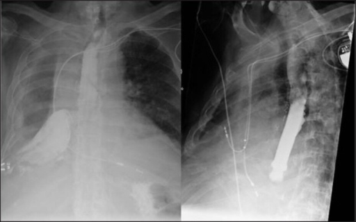 Barium swallow showing extravasation of oral contrast i | Open-i