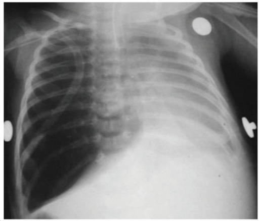 Chest X-ray of a child with congenital lobar emphysema | Open-i