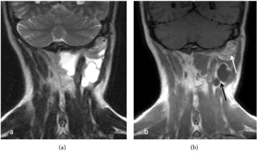 mri-findings-of-a-38-year-old-male-showed-a-multilobula-open-i