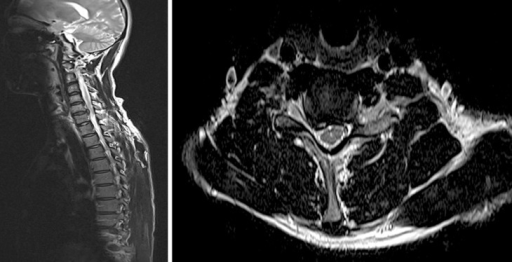 Pre-op MRI. A herniated cervical disc at C6/7 (Rt) was | Open-i