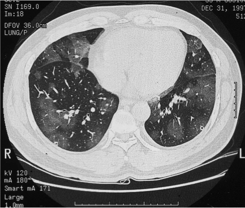 Lung CT showing multifocal ground-glass opacities in bo 