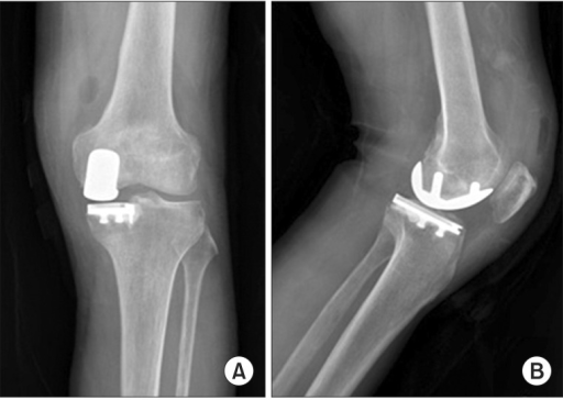 Radiologic Evaluation After Unicompartmental Knee Arthr | Open-i