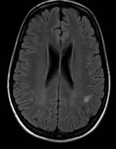 mri-brain-t2-flair-showing-high-intensity-signal-lesi-open-i