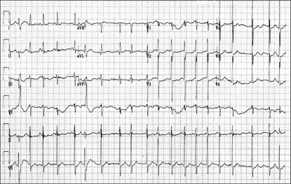 Multifocal atrial tachycardia (heart rate >100 beats | Open-i