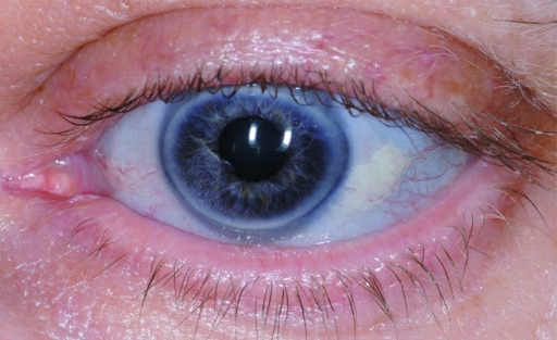 Blue Sclera Of Patient Open I 