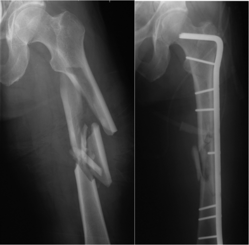 comminuted fracture