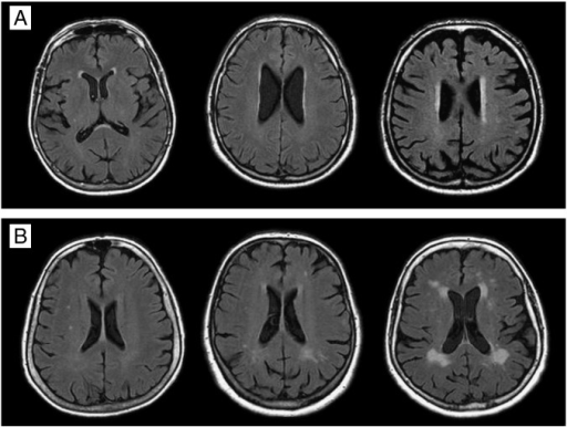 White matter lesions (WML) in T2-weighted FLAIR MRI sca | Open-i