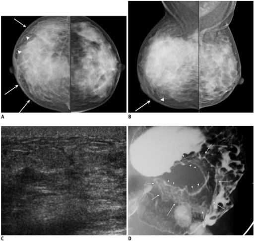 44-year-old woman with metastatic signet ring cell carc | Open-i