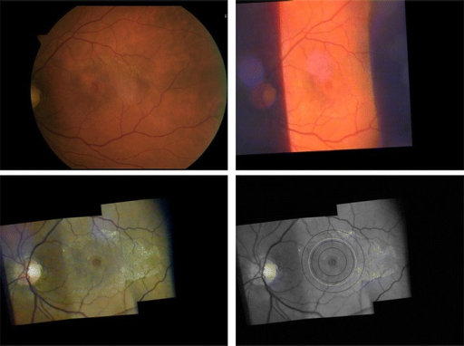 Comparison Between Fundus Photography And Slit Lamp Videography For A Right Eye With Macular Hole Comparison Between Fundus Photography And Slit Lamp Videography For A Right Eye With Macular Hole