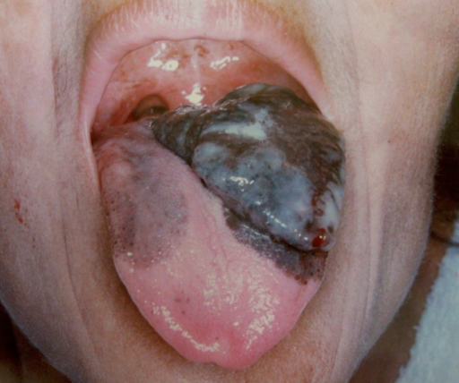 problem oral cavity definition patient Female old 44 oral year in tongue with melanoma