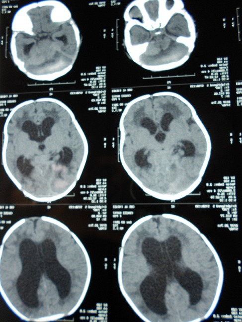 Scanner cerebral montrant un hematoma sous-dural de la | Open-i