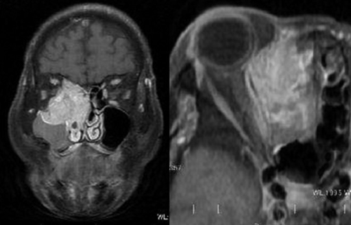 MRI showing a right-sided maxillary sinus tumor invadin | Open-i