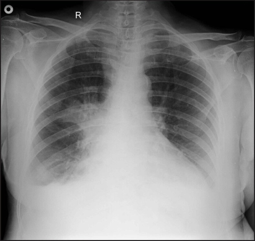 Chest x ray showing pneumonia