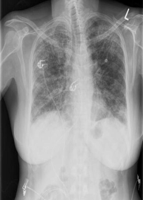 Chest radiograph showing diffuse, patchy bilateral inte | Open-i