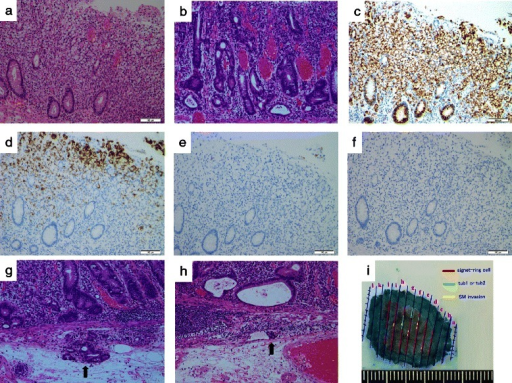 Clinicopathological and Corresponding Genetic Features of Colorectal Signet  Ring Cell Carcinoma | Anticancer Research