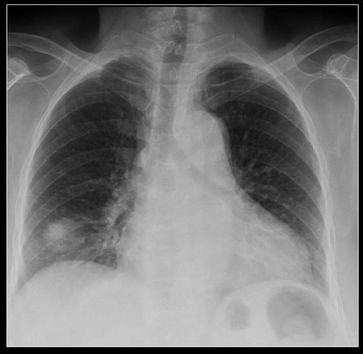 A chest radiograph showing a large PN at the right lung | Open-i