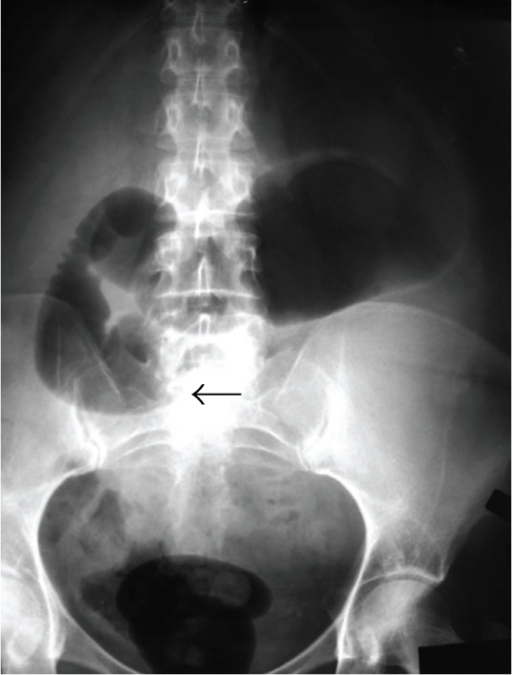 Abdominal X-ray demonstrating abrupt cut off sign at th | Open-i