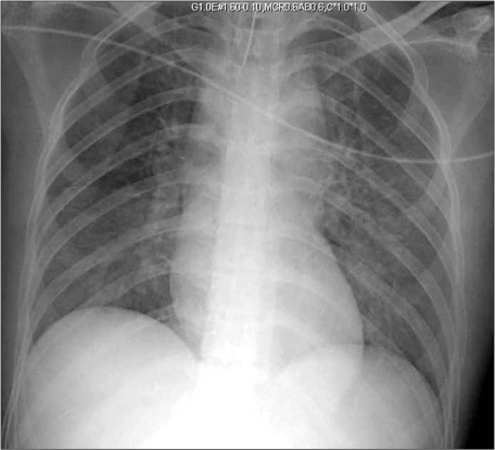 Chest X-ray showing severe pulmonary edema. | Open-i