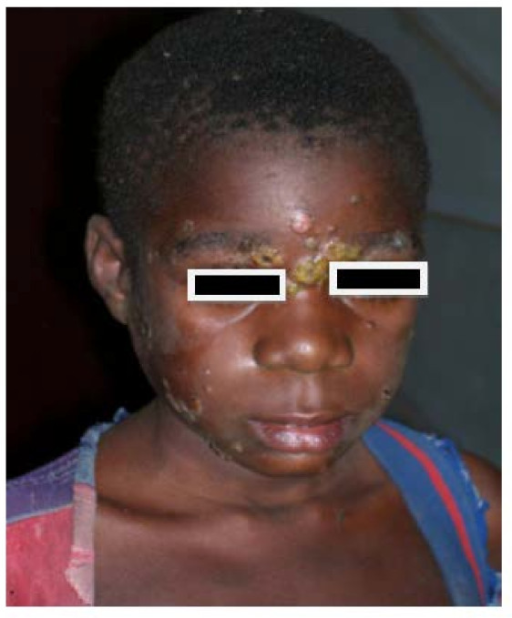 Active yaws lesions, Mongoumba, Central African Republi | Open-i