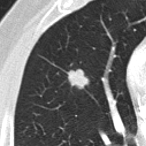 Pulmonary nodule with lobulated margins. | Open-i