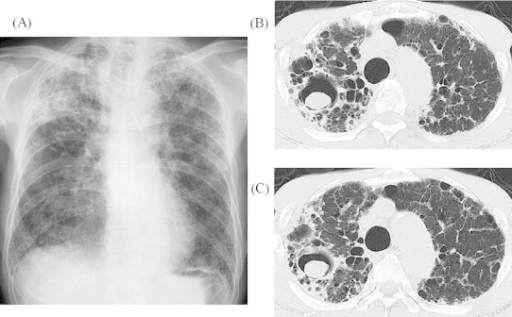 Chest X-ray (a) And Ct Scan (b, C) Obtained At The Firs 