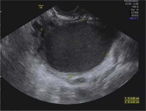 Ovarian Cyst Observed On Transvaginal Ultrasound In A 2 Open I 6323