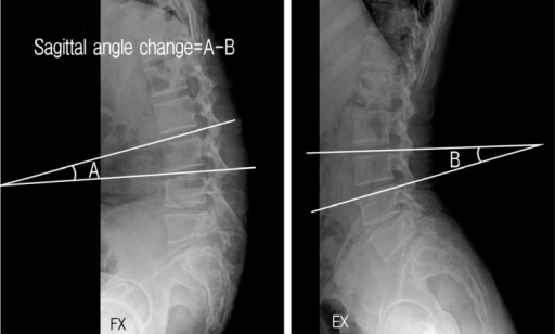 flexion extension x ray cervical spine
