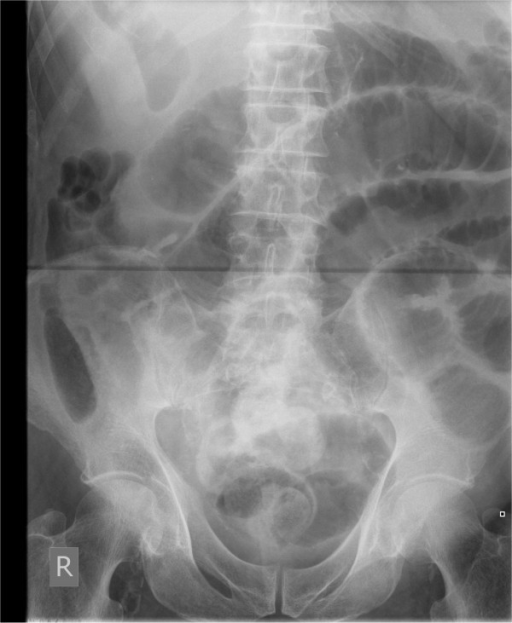 Abdominal X-ray of patient 1 showing dilated loops of s | Open-i