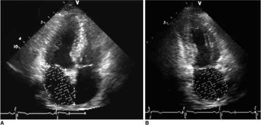 Measurement Of Left Atrial Volume Using Modified Biplan Open I 0984