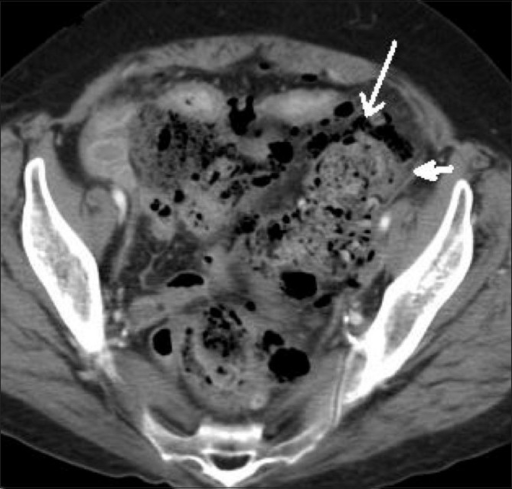 Contrast Enhanced Axial Ct Scan Demonstrates A Fecaloma Open I