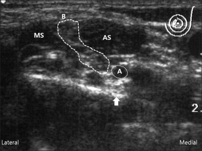 Ultrasound Image Of The Supraclavicular Approach. The A 