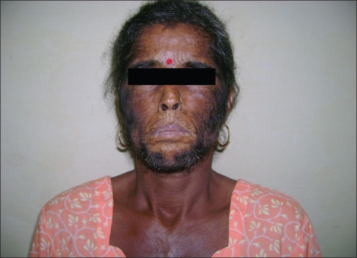 Approach to inherited hypertrichosis: A brief review - Indian