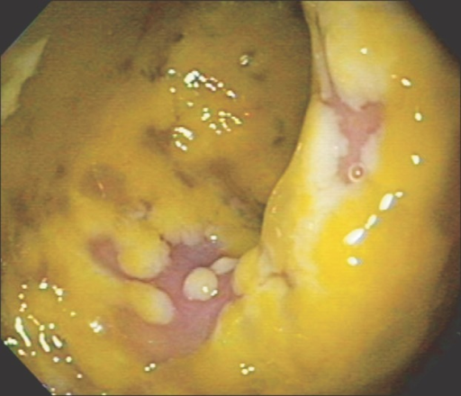 Pseudomembranous colitis. Appearance of pseudomembranes