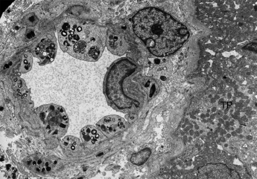 Kidney biopsy (electron microscopy): glycolipid inclusi | Open-i