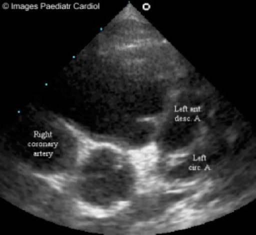 Parasternal short axis view at the aortic annulus demon | Open-i