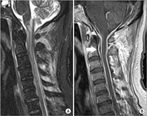 C-spine magnetic resonance imaging data. (A) T2 sagitta | Open-i