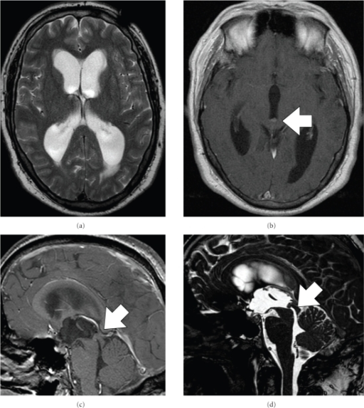 A T2 Weighted Mri Showing Marked Hydrocephalus T1 We Open I