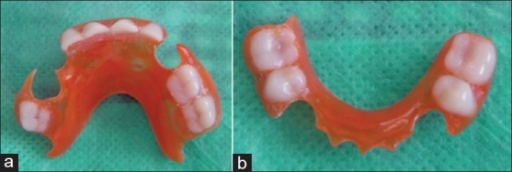 (a) The maxillary removable functional space maintainer | Open-i