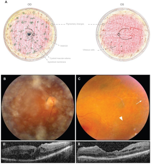 Twin A Displays Stage III ADNIV At The Age Of 49 Years Twin A Displays Stage III ADNIV At The Age Of 49 Years