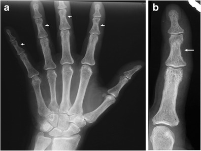 a, b: a Radiographic image of the left hand in a patien | Open-i