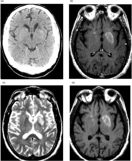 (a) Non-contrast CT scan showing ill-defined hyperdensi | Open-i
