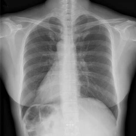 Chest X-ray showing dextrocardia and a right subphrenic | Open-i