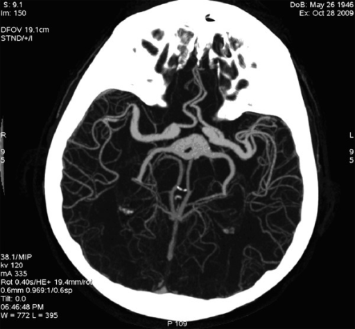 CTA, MIP reconstruction. Dolichoectasia of the circle o | Open-i