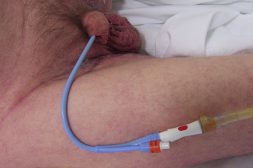 a catheter Is ok after masturbation