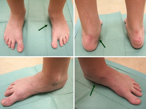 Asymptomatic, well-aligned foot in a teenager after sof | Open-i