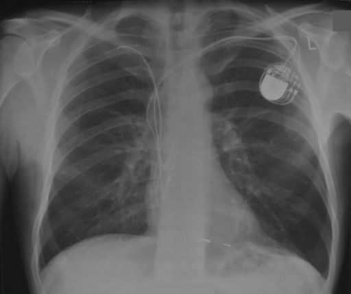 Chest X ray (PA) showing 2 atrial and 2 ventricular pac | Open-i