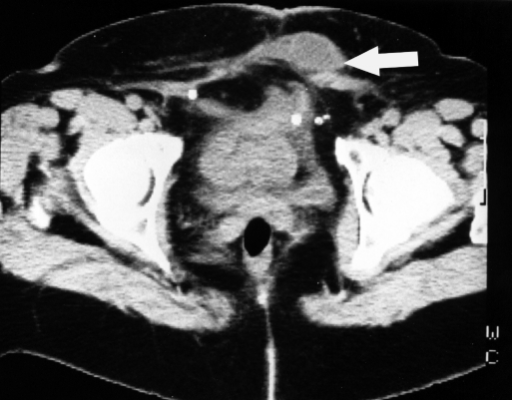 Ct Scan Of The Anterior Abdominal Wall A Seroma Is Rev Open I 2433